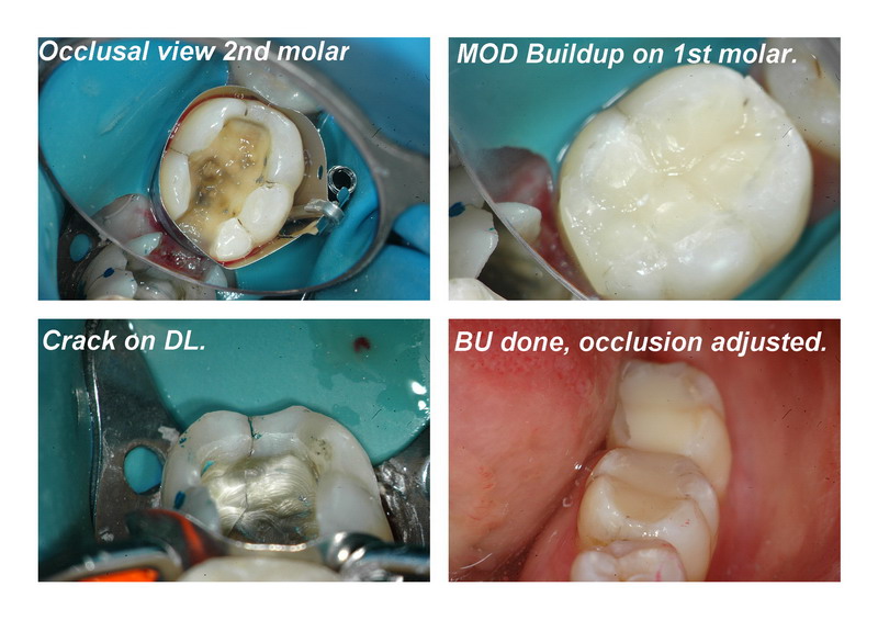 SB cracked tooth pg 2_resize.jpg